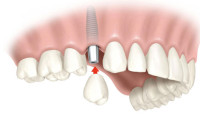 implante-dental