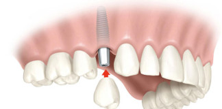 Implantes dentales