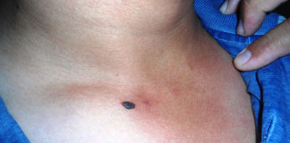 Alistan descarte de cáncer de piel por lunares sospechosos