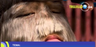 El exceso de Vello y Pelo: Hirpertricosis y el Hirsutismo