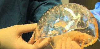 Niña con Hidrocefalia recibe trasplante de cráneo impreso en 3D