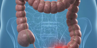 Prueban con éxito compuesto contra el Cáncer de Colon y Melanoma