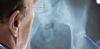 Personas extremadamente delgadas pueden padecer de osteoporosis