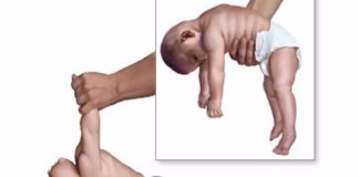 La enfermedad de Pompe que afecta a 600 peruanos