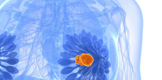 Tumores de mama necesitan de grasa para crecer