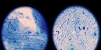 Nuevo tratamiento contra tuberculosis multirresistente