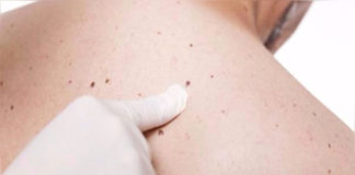 Heberferon es el nuevo medicamento contra el cáncer de piel