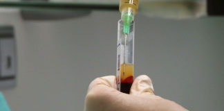 Revolucionario tratamiento usa imanes para purificar la sangre