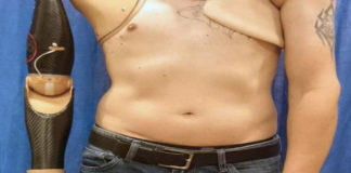 Crean prótesis de brazo que detecta señales de médula espinal