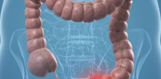 Importancia de la colonoscopia en la lucha contra el cáncer de colon