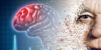 Aprenda a identificar los síntomas de un infarto cerebral