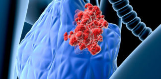 Aprueban nueva terapia genética contra el cáncer linfático agresivo