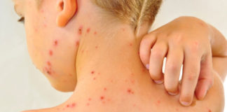 Minsa anuncia que comenzará vacunación contra la Varicela a niños a partir de un año