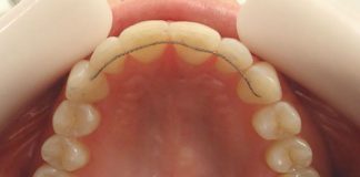 Tratamiento para dientes flojos