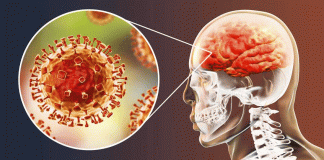 ¿Qué es y cómo tratar la Meningitis?