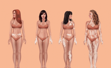 ¿Cuántos tipos de vitíligo existen?