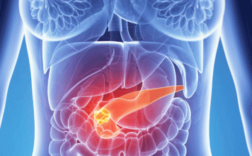 Conoce un poco más sobre el cáncer de páncreas