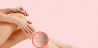 Lo que debes conocer de las várices