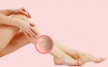 Lo que debes conocer de las várices